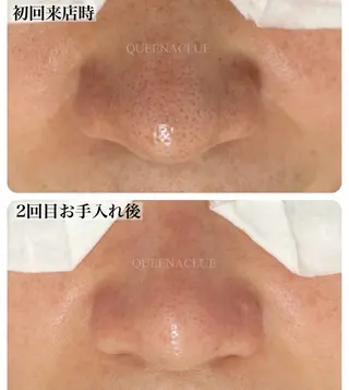 毛穴改善/脱毛 ネイル　川上久仁子のエステ・リラクイメージ