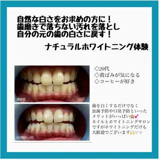 ネイル/耳つぼ /新ホワイトニングのネイルデザイン