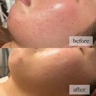 HINANO矢場町店【ヒナノ】所属・脱毛/肌改善🌿 HINANO 村田のエステ・リラクイメージ