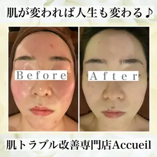 ミディアム カラー パーマ ヘアアレンジ メンズ キッズ ネイル マツエク・マツパ ニキビ・肌質改善専門 ♡人生が変わるサロンのエステ・リラクイメージ