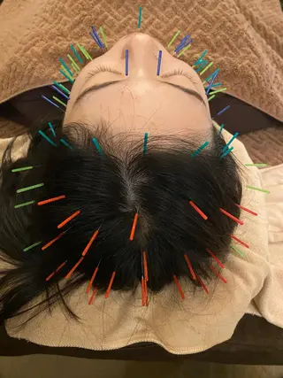 Acupuncture  salon LINOA リノア鍼灸院所属・ヘッドスパ鍼/小顔鍼 耳ツボ 　LINOAのエステ・リラクイメージ