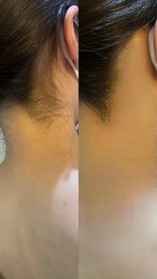 うなじ脱毛/美肌脱毛 LABELのエステ・リラクイメージ