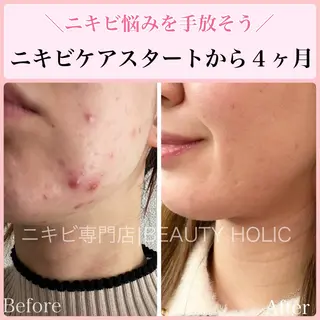 ニキビ・ 肌荒れ専門店のエステ・リラクイメージ