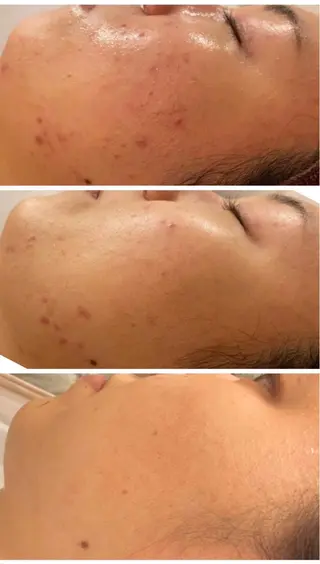 セミロング カラー パーマ ヘアアレンジ メンズ キッズ ネイル マツエク・マツパ アイブロウ ニキビ特化型エステ 🍓最短で肌質改善のエステ・リラクイメージ