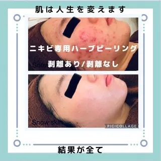 ニキビ/肌質改善専門 Snow skinのエステ・リラクイメージ