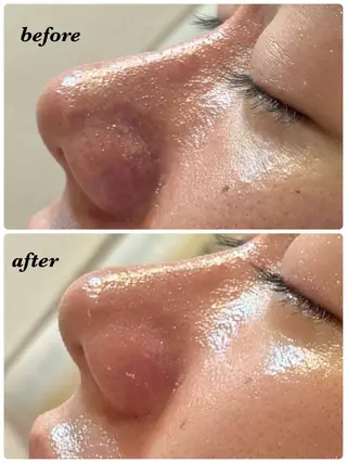 ハーブピーリング/韓国肌管理/フェイシャル/毛穴洗浄/眉毛/顔脱毛【糸脱毛専門】rev所属・ハーブピーリング🌹 毛穴洗浄❤️眉waxのエステ・リラクイメージ