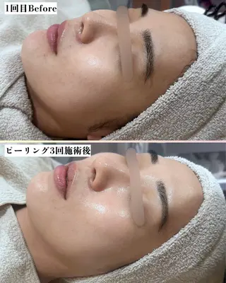 |ピーリング・毛穴| soina神楽坂のエステ・リラクイメージ