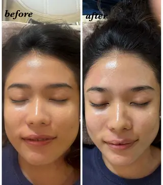 ハーブピーリング/韓国肌管理/フェイシャル/毛穴洗浄/眉毛/顔脱毛【糸脱毛専門】rev所属・ハーブピーリング🌹 毛穴洗浄❤️眉waxのエステ・リラクイメージ