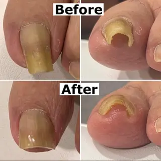 ネイル Mellow nail所属・巻爪無料モデル募集 ✨🦶MEGUMIのネイルデザイン