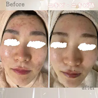 ニキビ&跡改善サロン オーナー光木のエステ・リラクイメージ