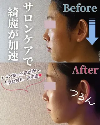 痩身ハーブピーリング 筋膜リリース☆B&Hのエステ・リラクイメージ