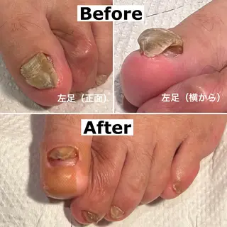 ネイル Mellow nail所属・巻爪無料モデル募集 ✨🦶MEGUMIのネイルデザイン