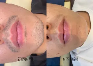 脱毛 シエスタ 山下 上級脱毛士のエステ・リラクイメージ