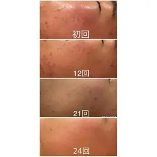 6万人の美肌実績🔥 最短ニキビ改善のエステ・リラクイメージ