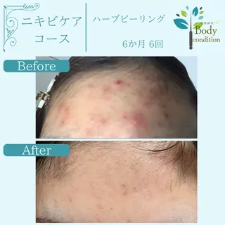 小顔ハーブピーリング 美容鍼/毛穴洗浄のエステ・リラクイメージ