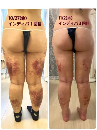 メディカル インディバサロン同心のエステ・リラクイメージ