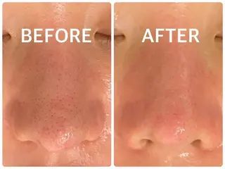 ハーブピーリング 🌿京橋のエステ・リラクイメージ