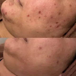 ダウンタイムなし🌷 優しい肌質改善のエステ・リラクイメージ