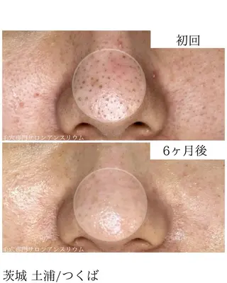 毛穴ケア専門サロンアンスリウム所属・茨城土浦 つくば毛穴 ケア専門サロンのエステ・リラクイメージ