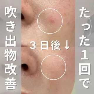 ニキビ・ニキビ跡改善 leoloのエステ・リラクイメージ