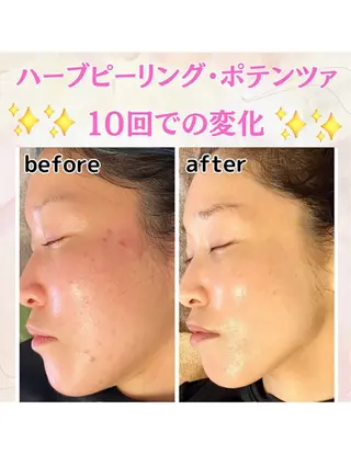 【韓国肌管理】ハーブピーリング　A.DIOR   GINZA所属・松尾 実歩のエステ・リラクイメージ