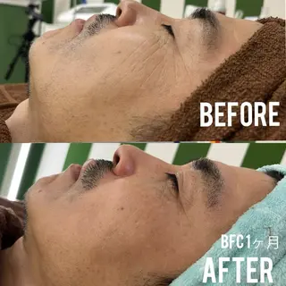 MEITY新宿所属・小顔、毛穴ケア 通い放題エステのエステ・リラクイメージ