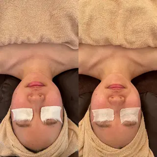 毛穴ケア/毛穴診断/ 毛穴洗浄〔心斎橋〕のエステ・リラクイメージ