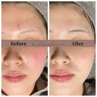 beauty & health salon Chou chou所属・ニキビ・毛穴🌿肌を 育てるララピール✨のエステ・リラクイメージ