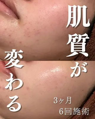 🔥3か月で肌革命 🔥ニキビ専門店のエステ・リラクイメージ