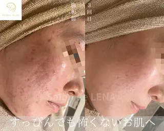 サロンドレナ名駅店所属・ハーブピーリング専門 サロンドレナ平岡のエステ・リラクイメージ