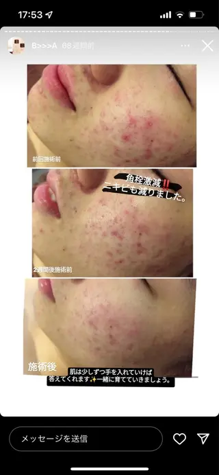 ニキビ跡改善専門🔥 医療にはできない改善のエステ・リラクイメージ