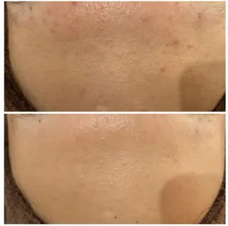 ニキビ跡改善専門🔥 医療にはできない改善のエステ・リラクイメージ