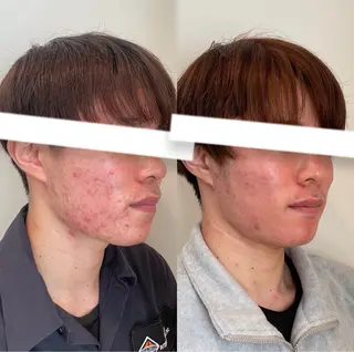 メンズ 美容鍼灸サロン　TIARA所属・鍼灸サロン TIARA　美容鍼のエステ・リラクイメージ