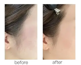 トータルサロンRuby所属・【医療提携】小顔 整体ハーブピーリングのその他イメージ