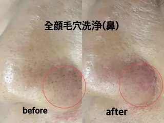 肌ケア＆毛穴洗浄 Cheriのエステ・リラクイメージ