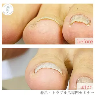 ネイル 深爪・巻き爪 専門サンセリテのネイルデザイン