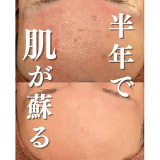 ニキビ特化型エステ 🍓最短で肌質改善のエステ・リラクイメージ