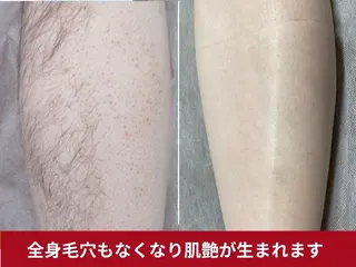 脱毛サロンエピラージュ町田店所属・脱毛専門店 エピラージュのエステ・リラクイメージ