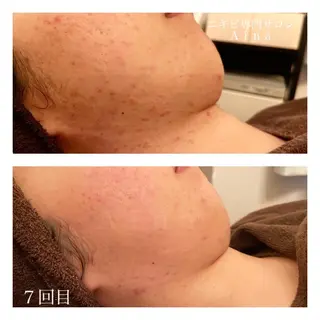 セミロング カラー パーマ ヘアアレンジ メンズ キッズ ネイル マツエク・マツパ ニキビ跡専門サロン Ainaのエステ・リラクイメージ