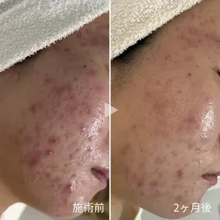 シェノン所属・ニキビ・毛穴・ フェイシャル専門店のエステ・リラクイメージ