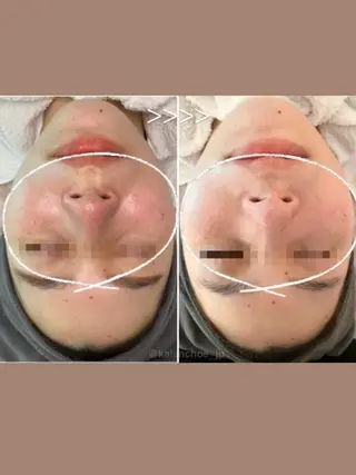 肌質改善 KALANCHOEのエステ・リラクイメージ