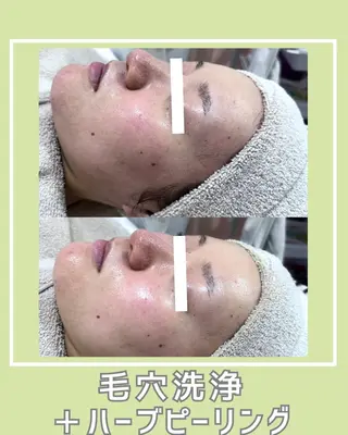 |ピーリング・毛穴| soina神楽坂のエステ・リラクイメージ