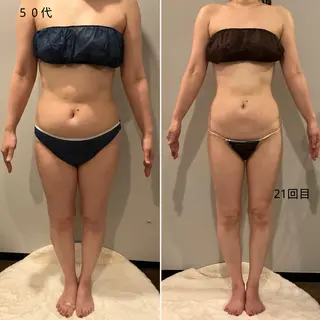 ✨痩身 ✨ハイパーナイフEXのエステ・リラクイメージ