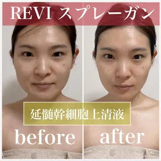 マツエク・マツパ ニキビ・毛穴改善 🌿ハーブピーリングのエステ・リラクイメージ