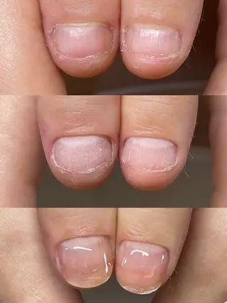 ネイル ネイリストゆか💅 長さだし、深爪矯正のネイルデザイン