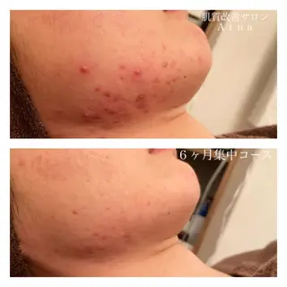 セミロング カラー パーマ ヘアアレンジ メンズ キッズ ネイル マツエク・マツパ ニキビ跡専門サロン Ainaのエステ・リラクイメージ