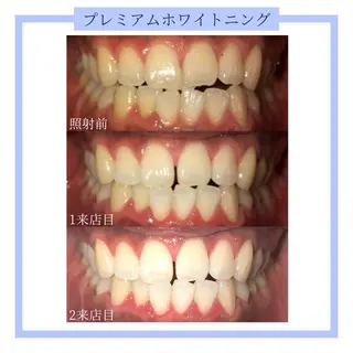 ホワイトニング｜韓国式3D毛穴洗浄 lonhana ﾛﾝﾊﾅ所属・韓国式3D毛穴洗浄 lonhanaのその他イメージ