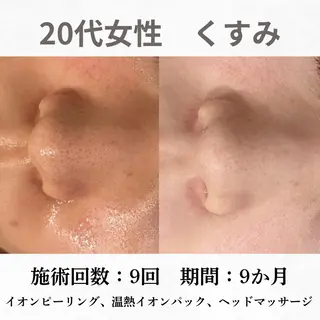 重度ニキビ専門🌷 ダウンタイムなしのエステ・リラクイメージ