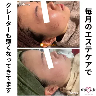 Meupニキビ専門店 背中/ハーブ/肌管理のその他イメージ