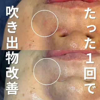 ニキビ・ニキビ跡改善 leoloのエステ・リラクイメージ